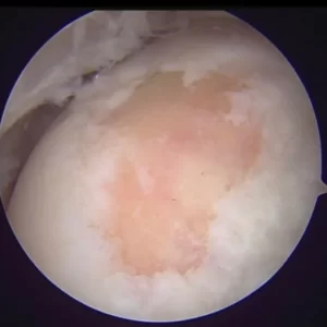 Lesión de cartilago de rodilla