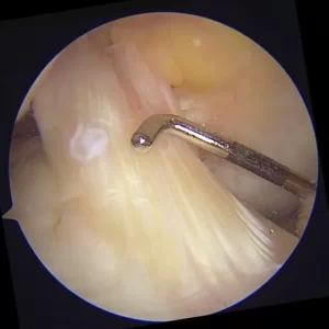 Ligamento cruzado anterior sano