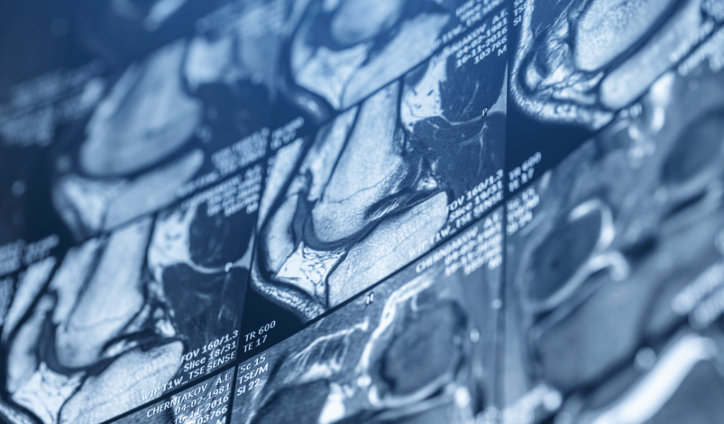 resonancia-de-rodilla